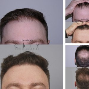 Hair-Transplant