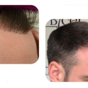 hairline.repair.jpg