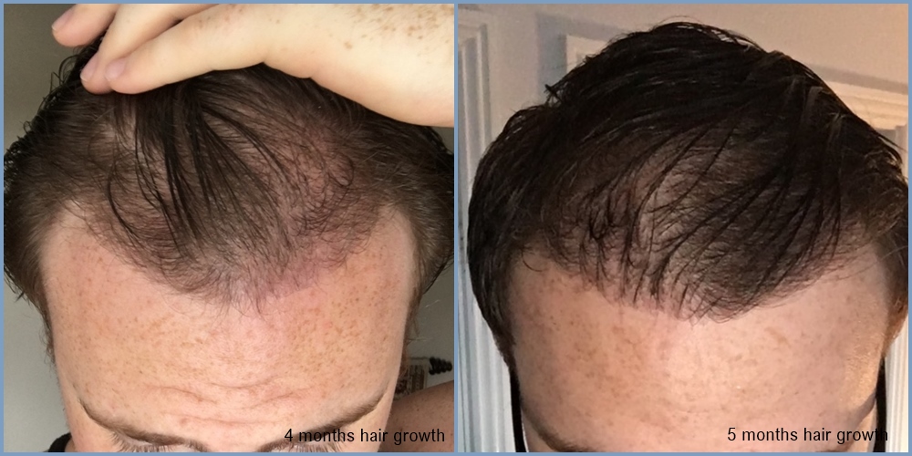 4-5-month-post-op-dr-nikos-hair-transplant.jpg