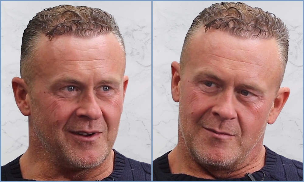 after-sides-dr-nikos-hairtransplant-result.jpg