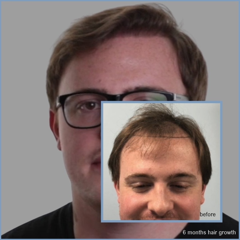 before-6-month-dr-nikos-hair-transplant.jpg