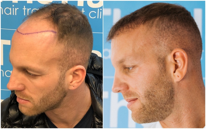 before-after-fue-hair-dr-dr-arshad-left.jpg