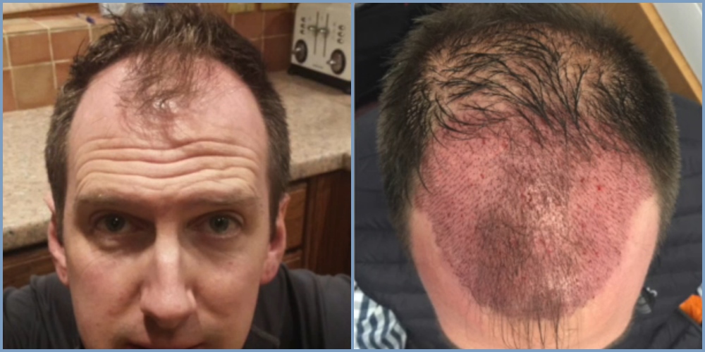 before-graft-placement-dr-nikos-hair-transplant.jpg