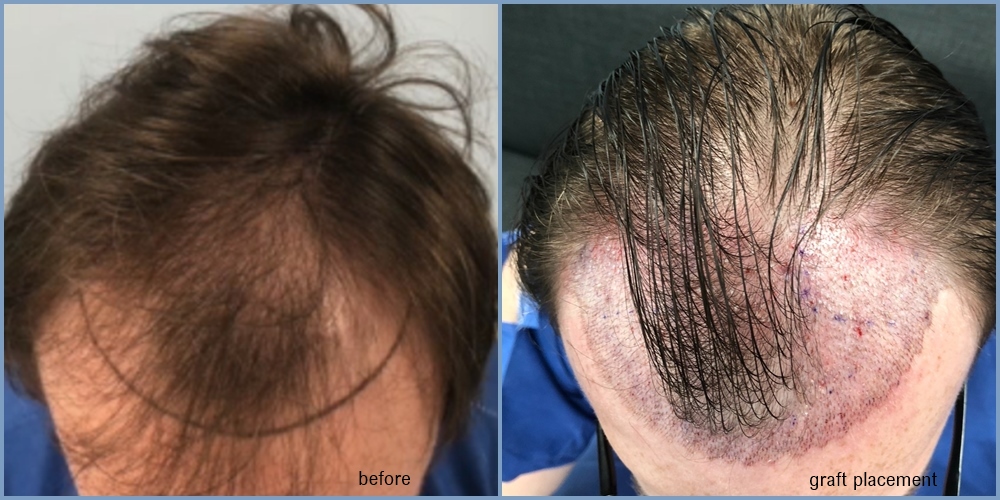 before-graft-placement-dr-nikos.jpg