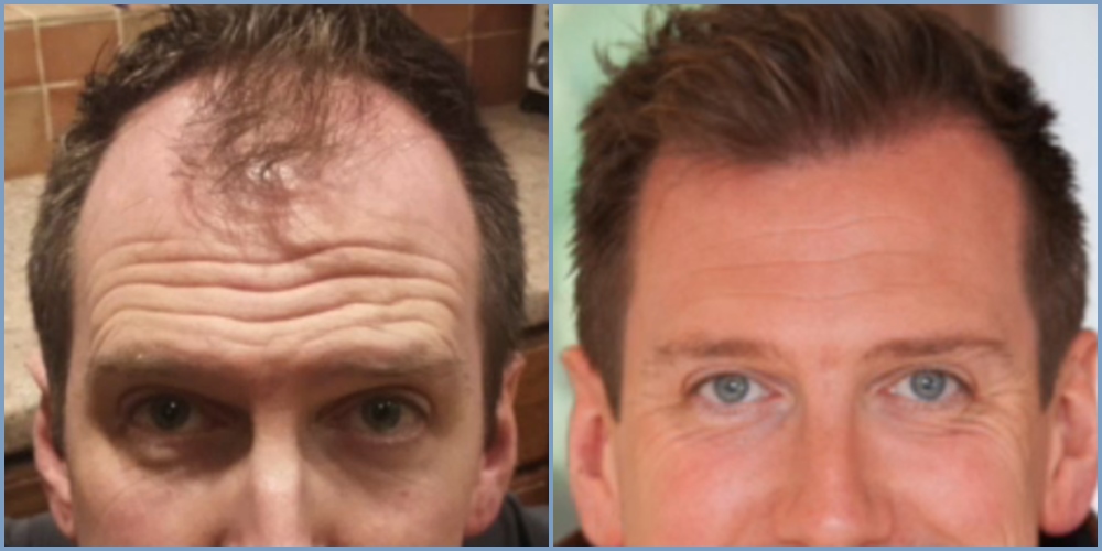 before-hair-transplant-result-dr-nikos.jpg