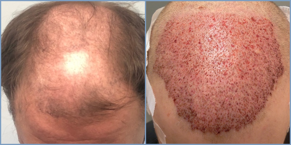 before-placement-dr-nikos-hair-transplant.jpg