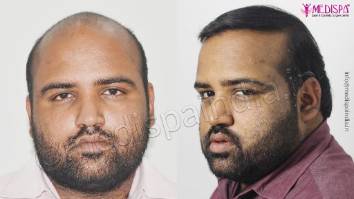 Best hair transplant results in India