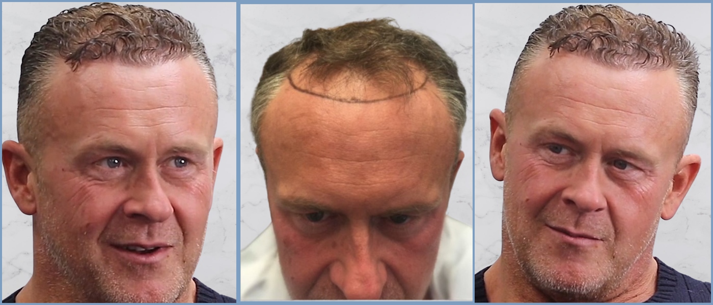 collage-before.result-dr-nikos-hair-tranplant.jpg