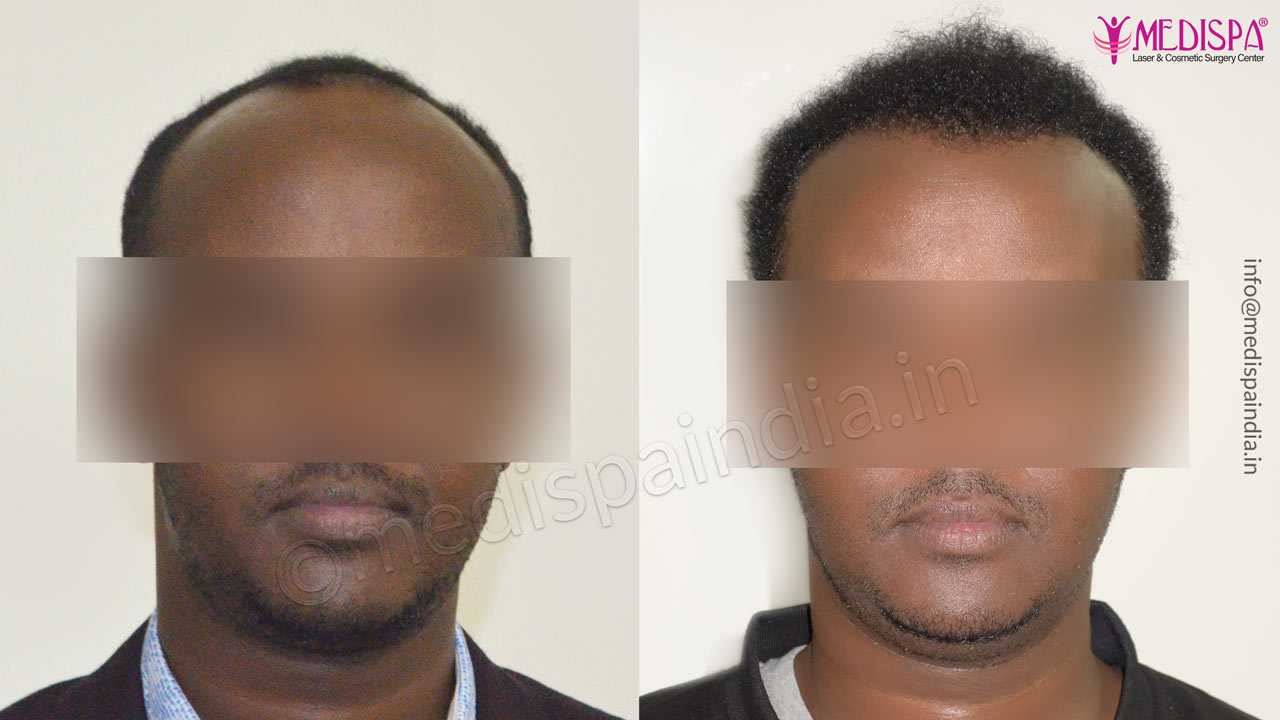 curly hair transplant at Medispa