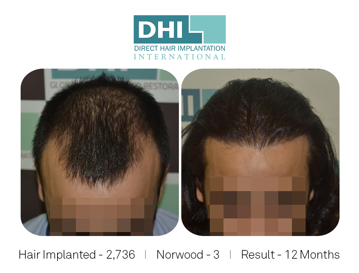 DHI - Hair Transplant Success Story 2