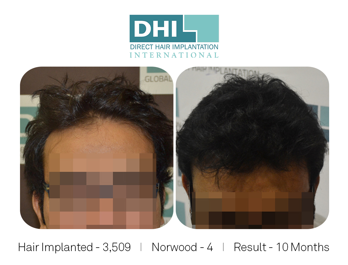DHI - Hair Transplant Success Story 3