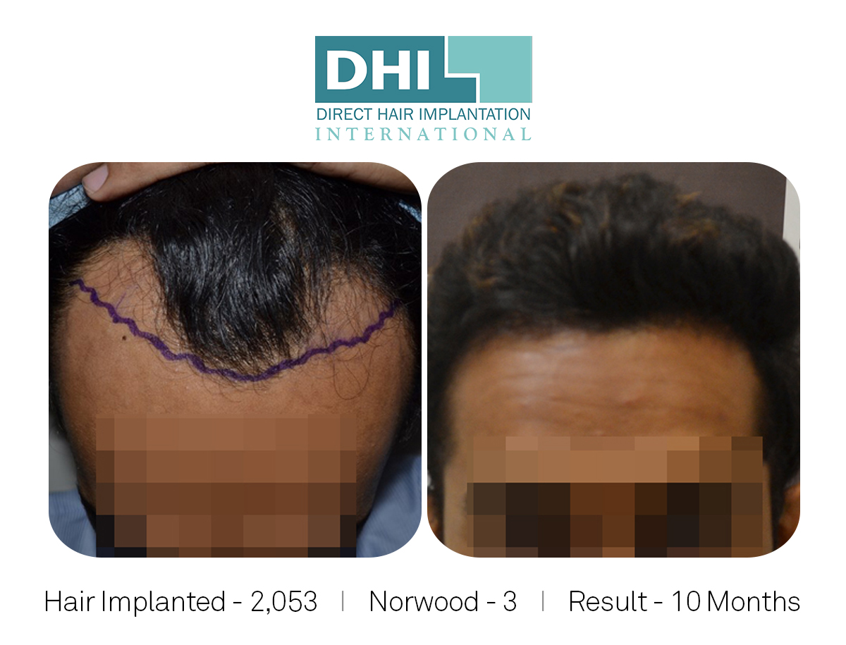 DHI - Hair Transplant Success Story 4