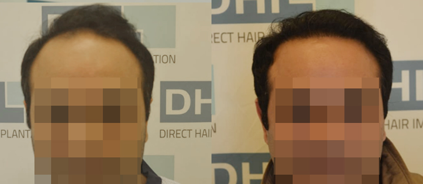 DHI - Hair Transplant Success Story 6