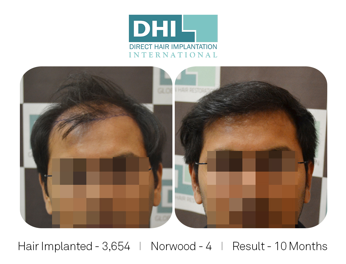 DHI - Hair Transplant Success Story 7