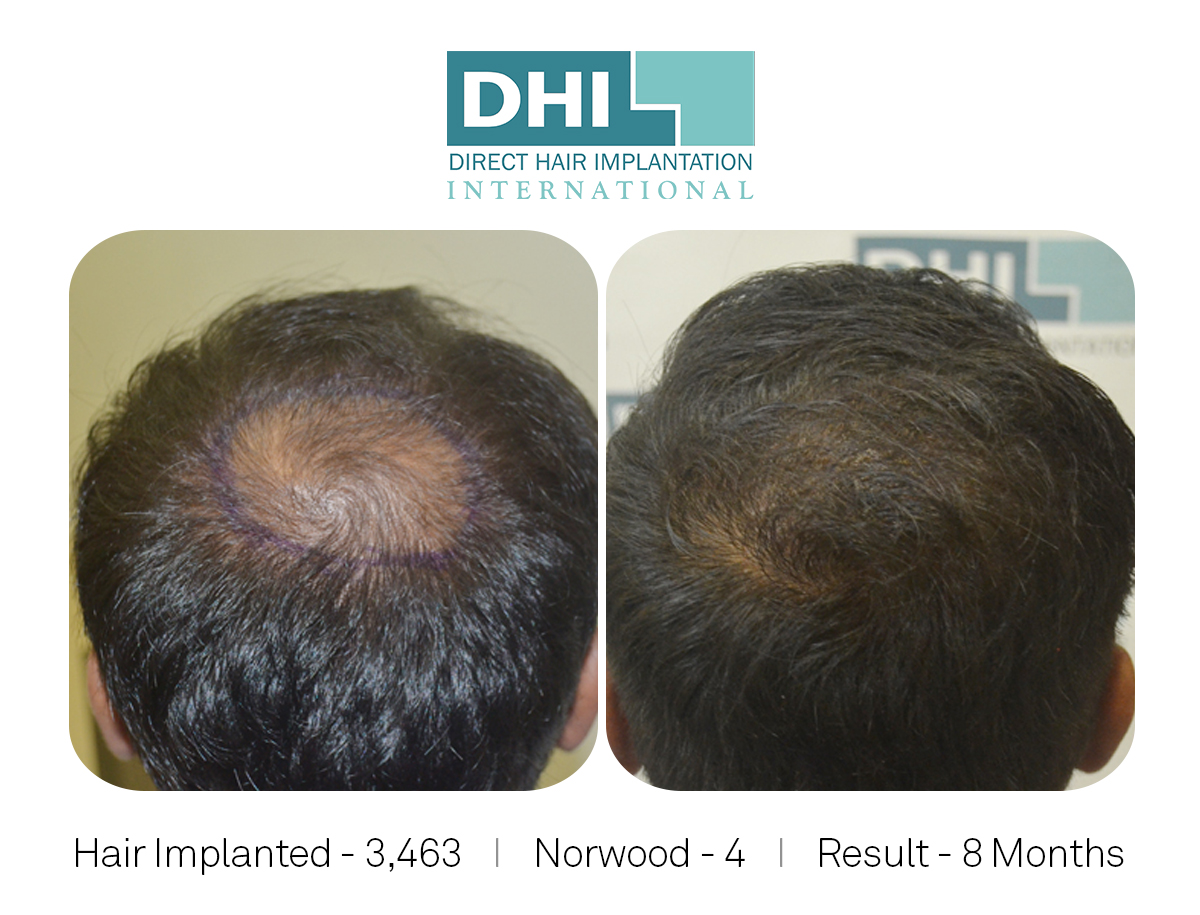 DHI - Hair Transplant Success Story
