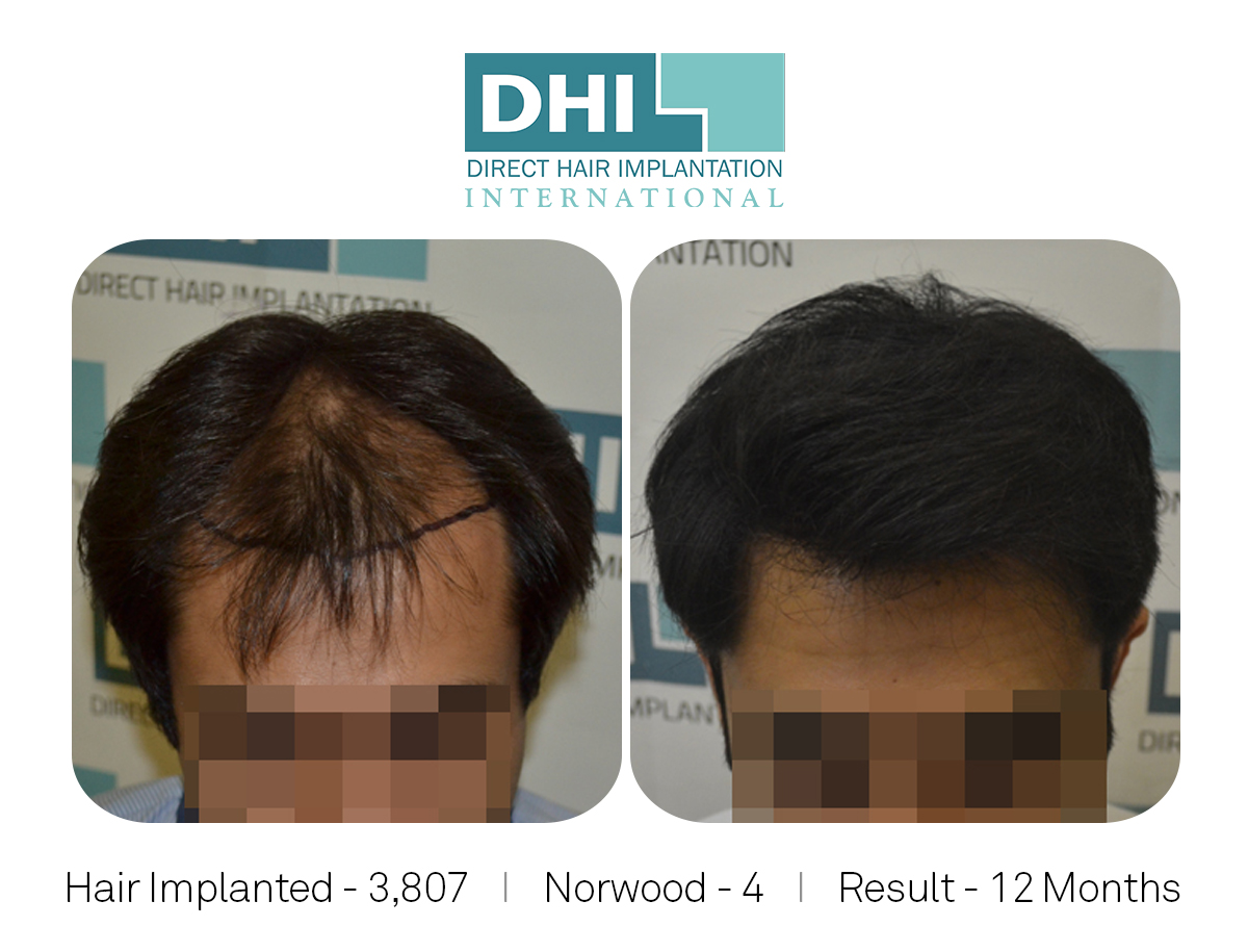 DHI Success Story   - Hair Transplant Before and After Results.