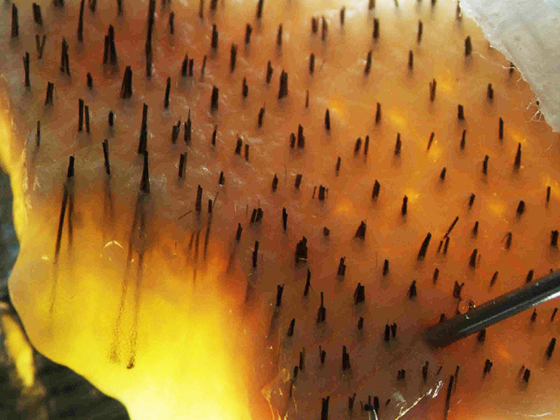Donor-area-hair-transplant-fut.jpg
