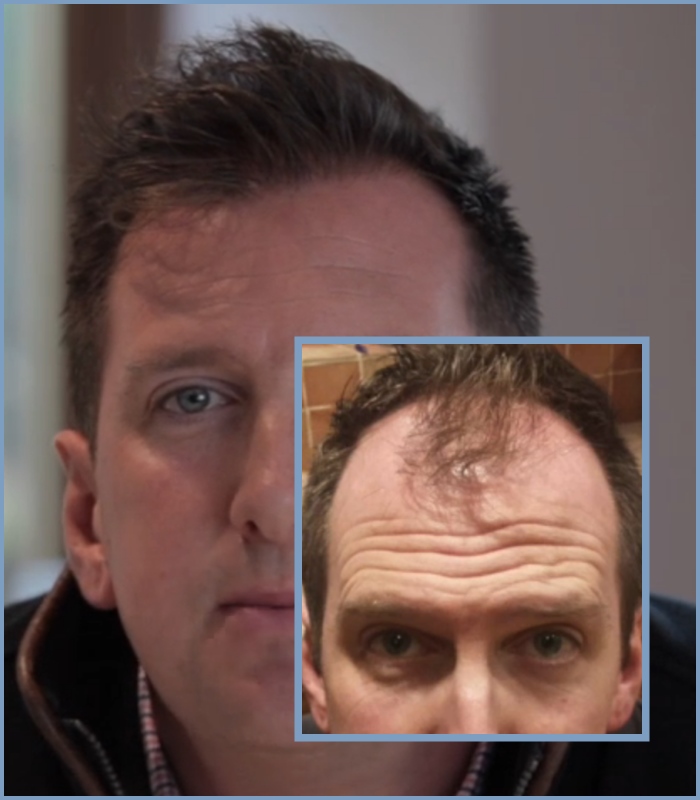 dr-nikos-hair-transplant-result.1.jpg