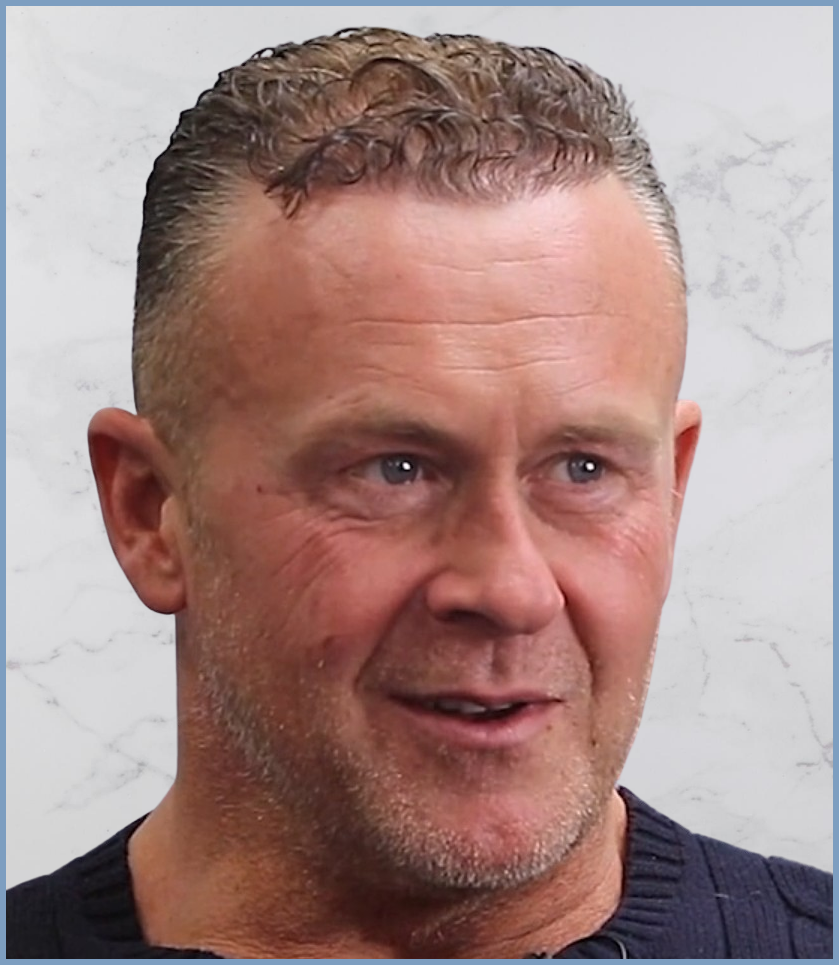 Dr-Nikos-hair-transplant-result.1.png