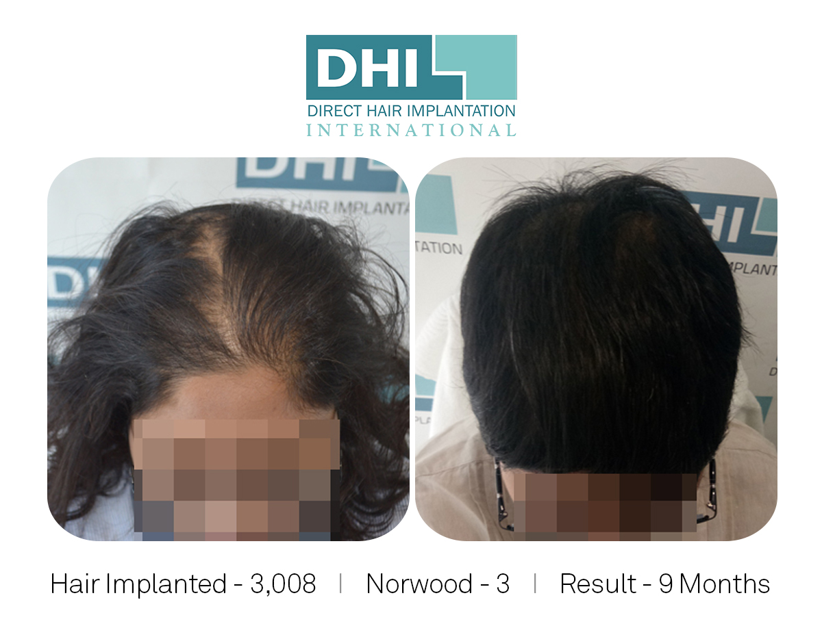 Female Hair Transplant Results - DHI