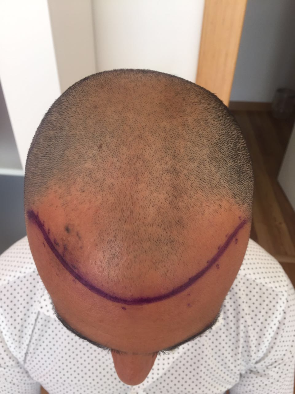 FUE 3250 GREFT BY DR. BİCER