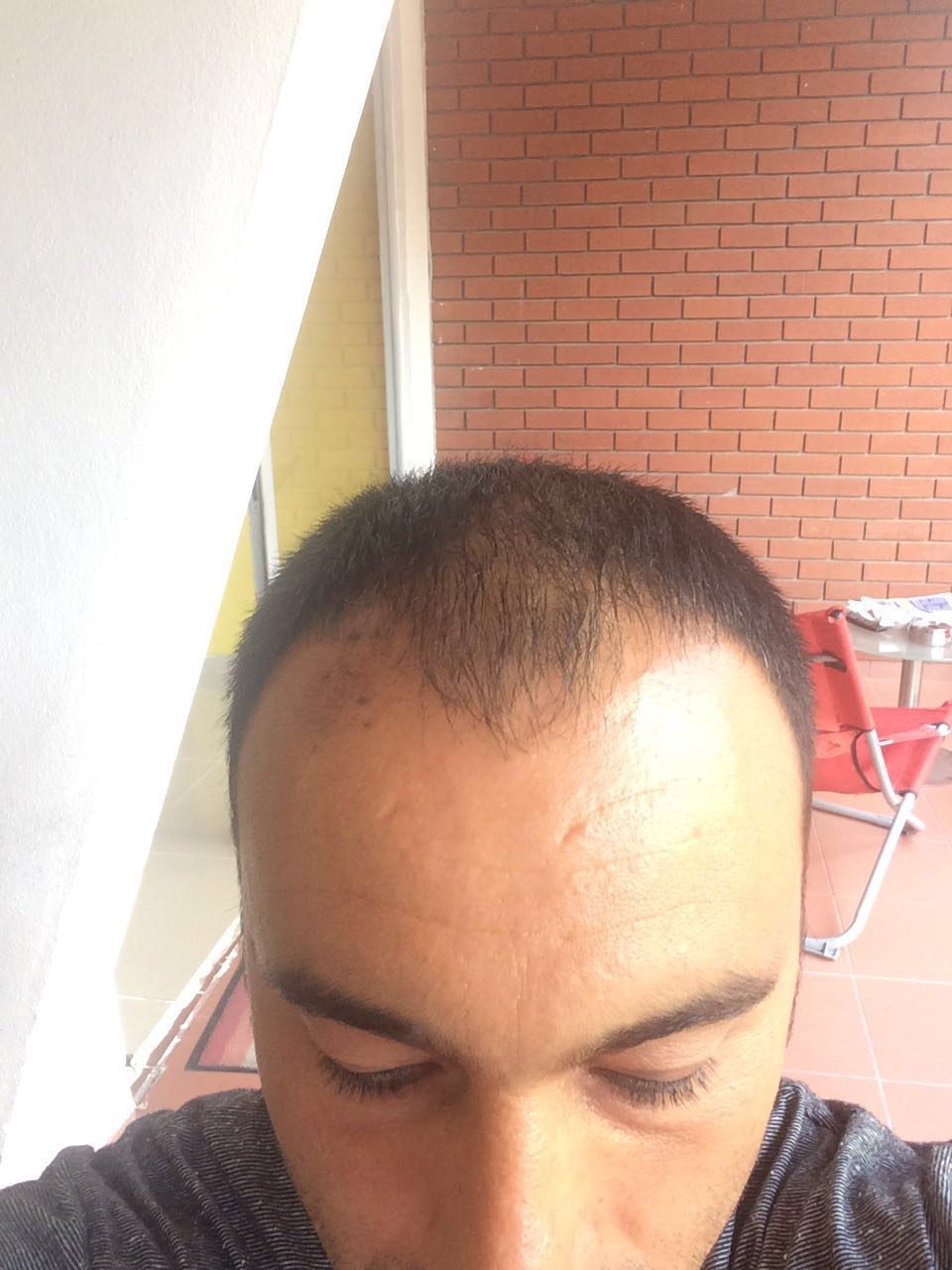 FUE 3250 GREFT BY DR. BİCER