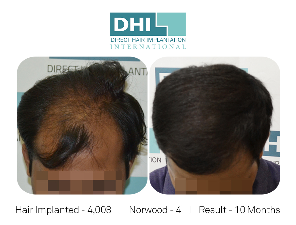 Hair Transplant Amazing Results