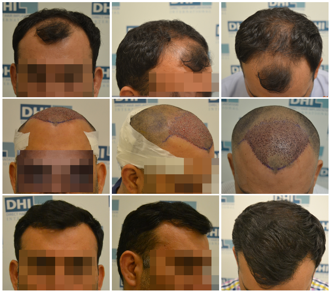 Hair Transplant Amazing Results