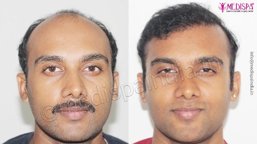 Hair transplant before and after results - Medispa India
