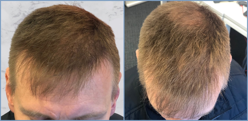 hair-transplant-result-dr-nikos.jpg
