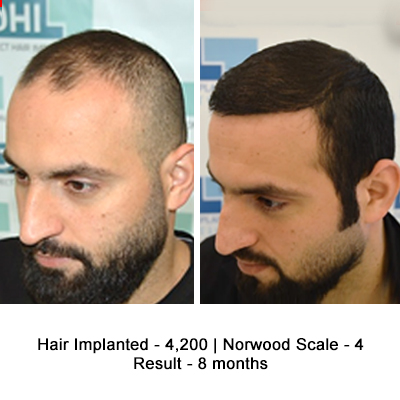 Hair Transplant Results of a Celebrity Hair Stylist