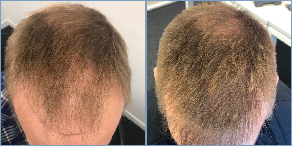 hair-transplant-top-result-dr-nikos.jpg