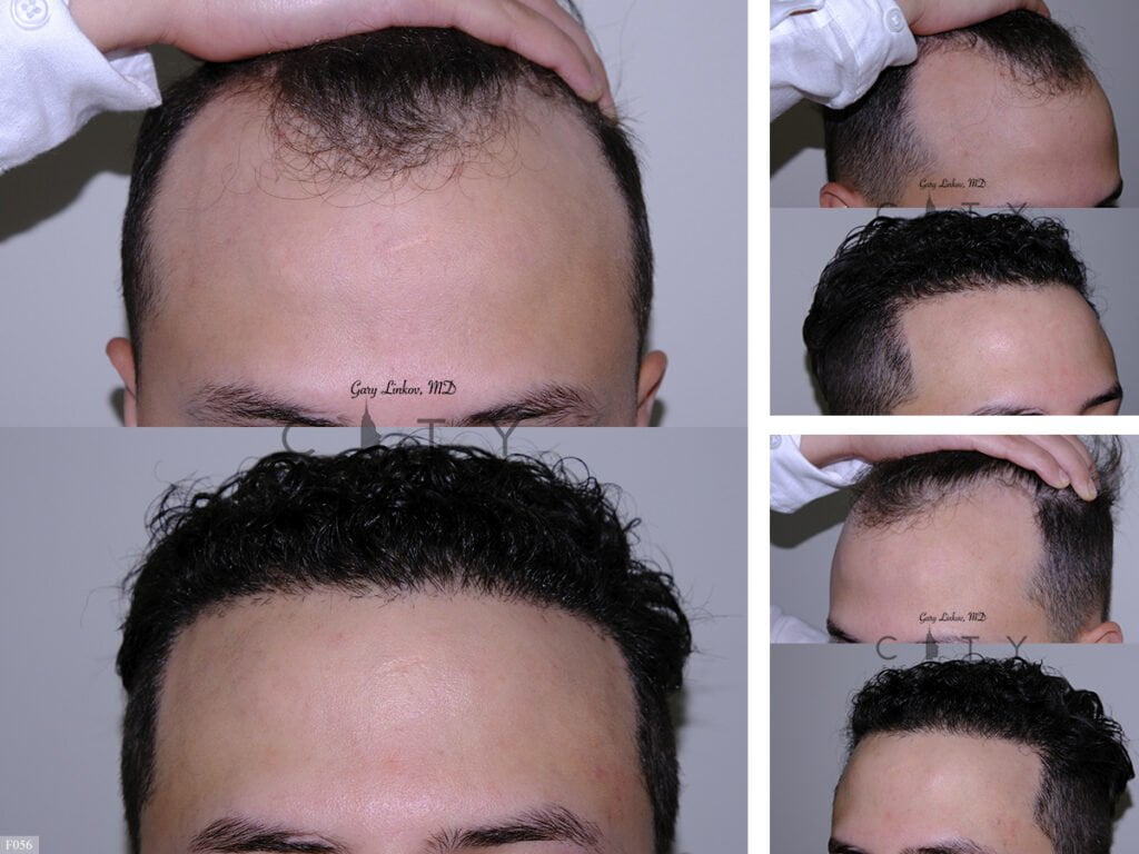 Hair-Transplant