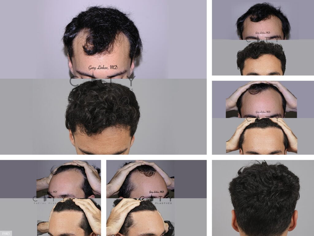 Hair-Transplant
