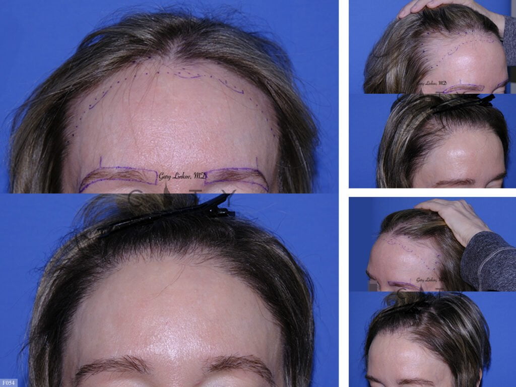 Hair-Transplant