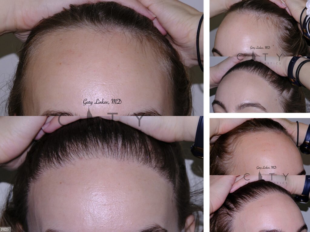 Hair-Transplant