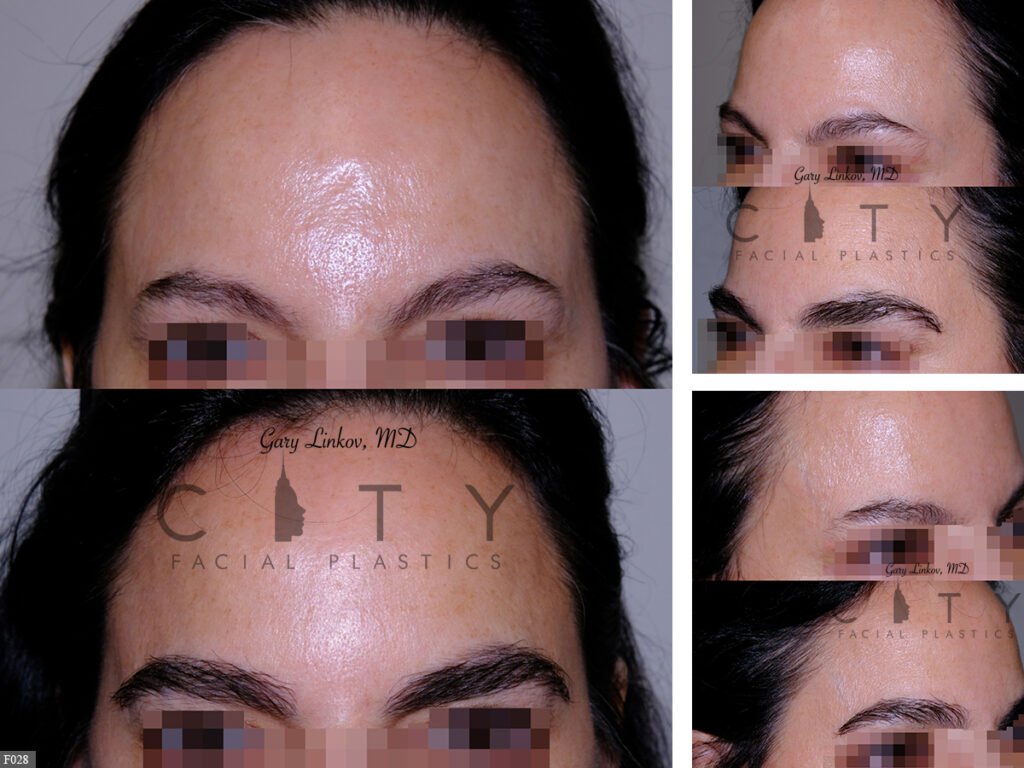 Hair-Transplant