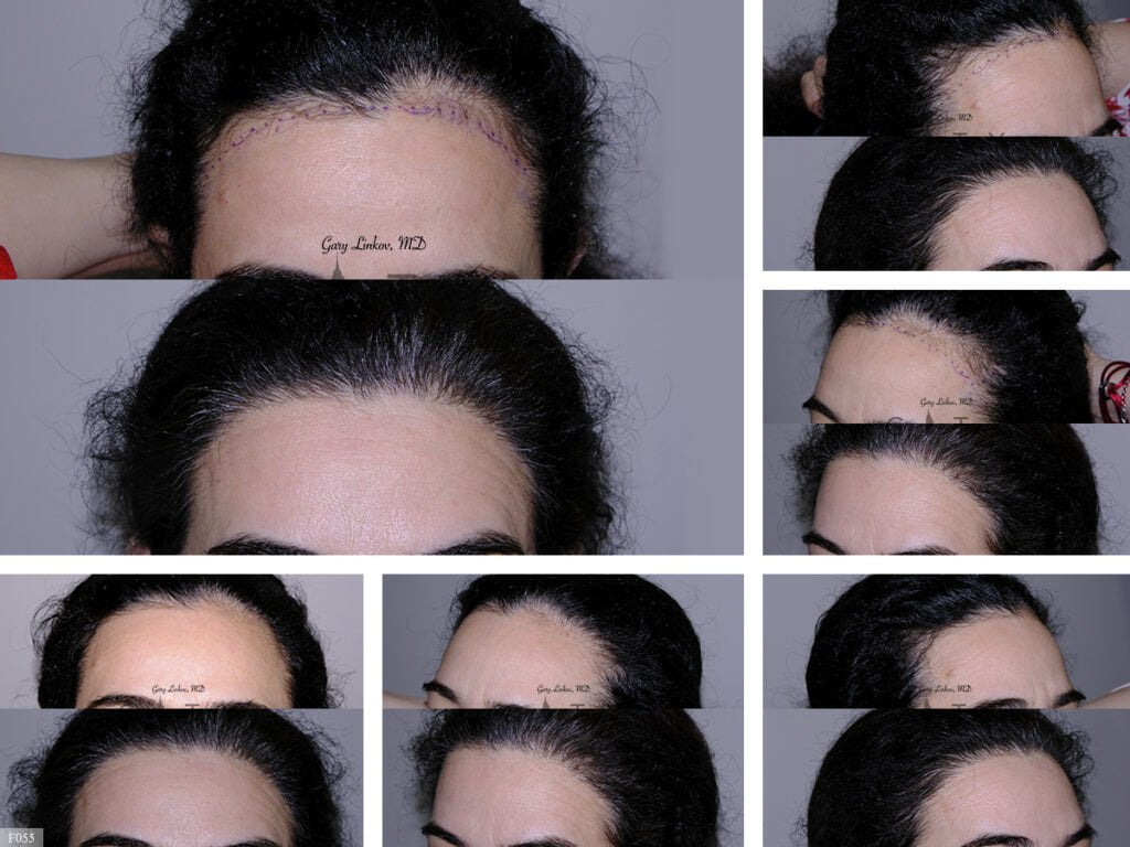 Hair-Transplant