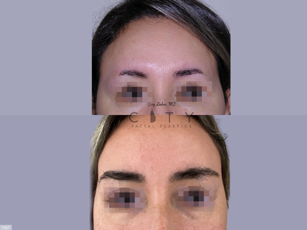 Hair-Transplant