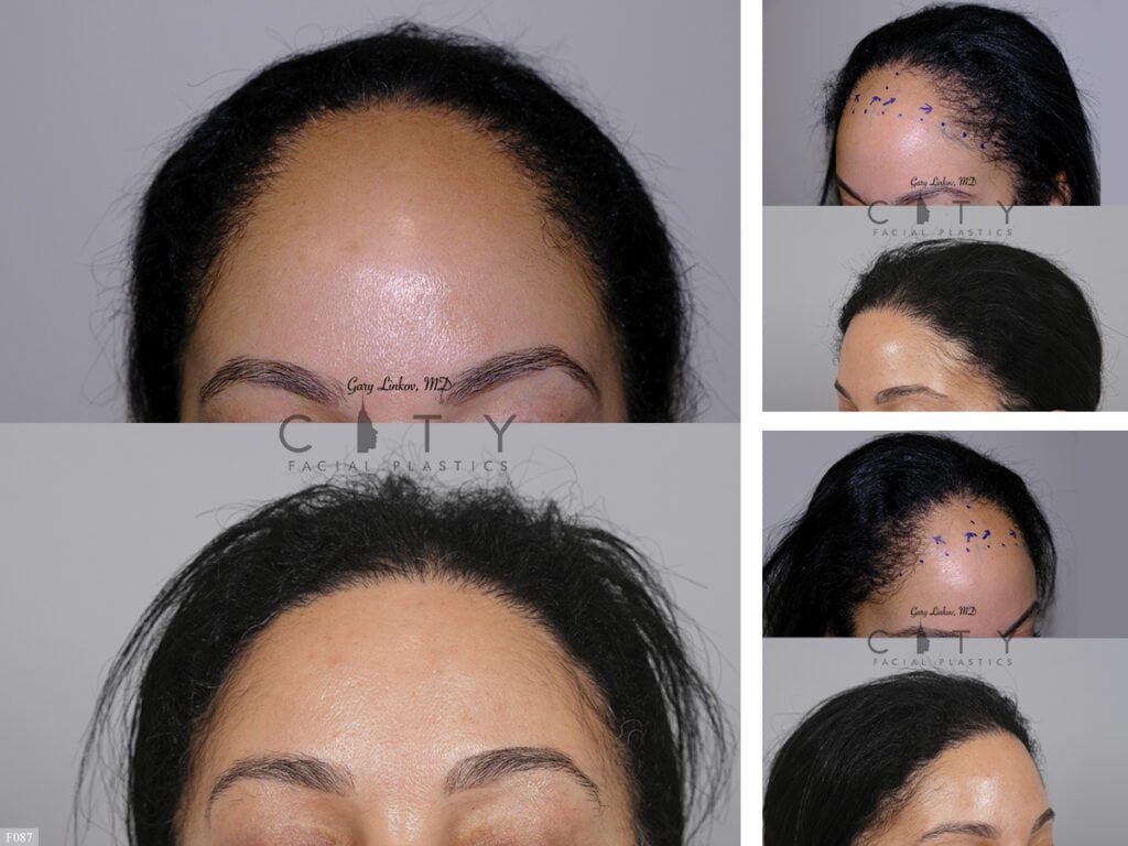 Hair-Transplant