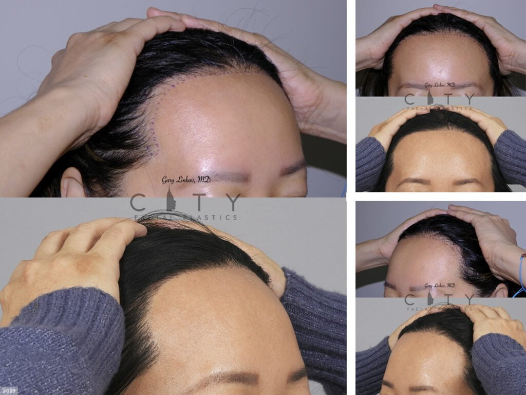 Hair-Transplant