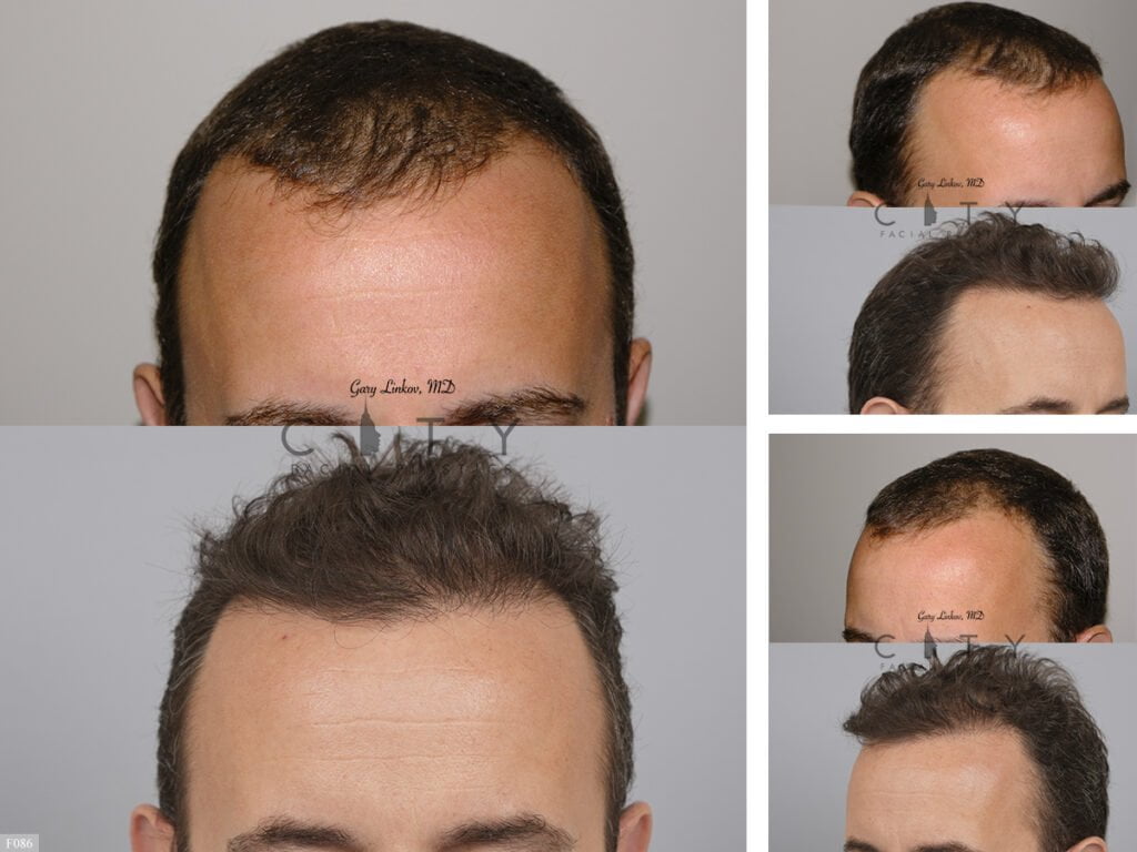Hair-Transplant