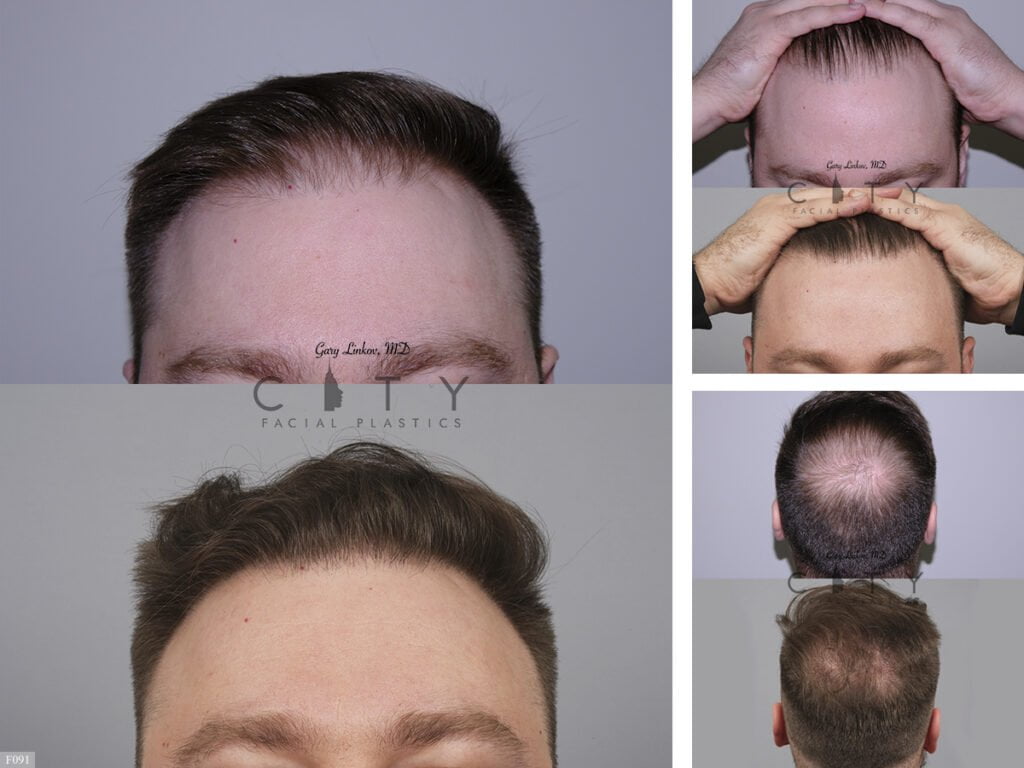 Hair-Transplant