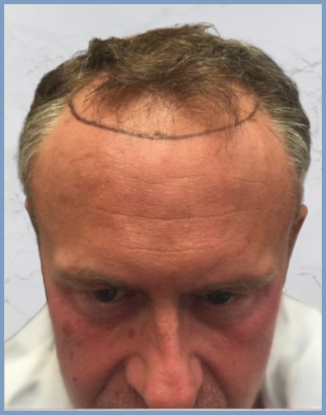 hairline-design-dr-nikos-hair-transplant-.png