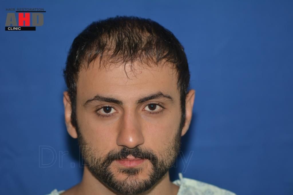 Identical twin hair transplant 1.jpg