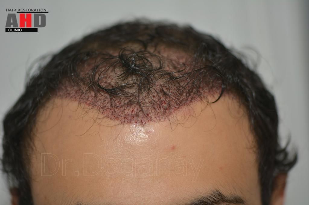 Identical twin hair transplant 11.jpg