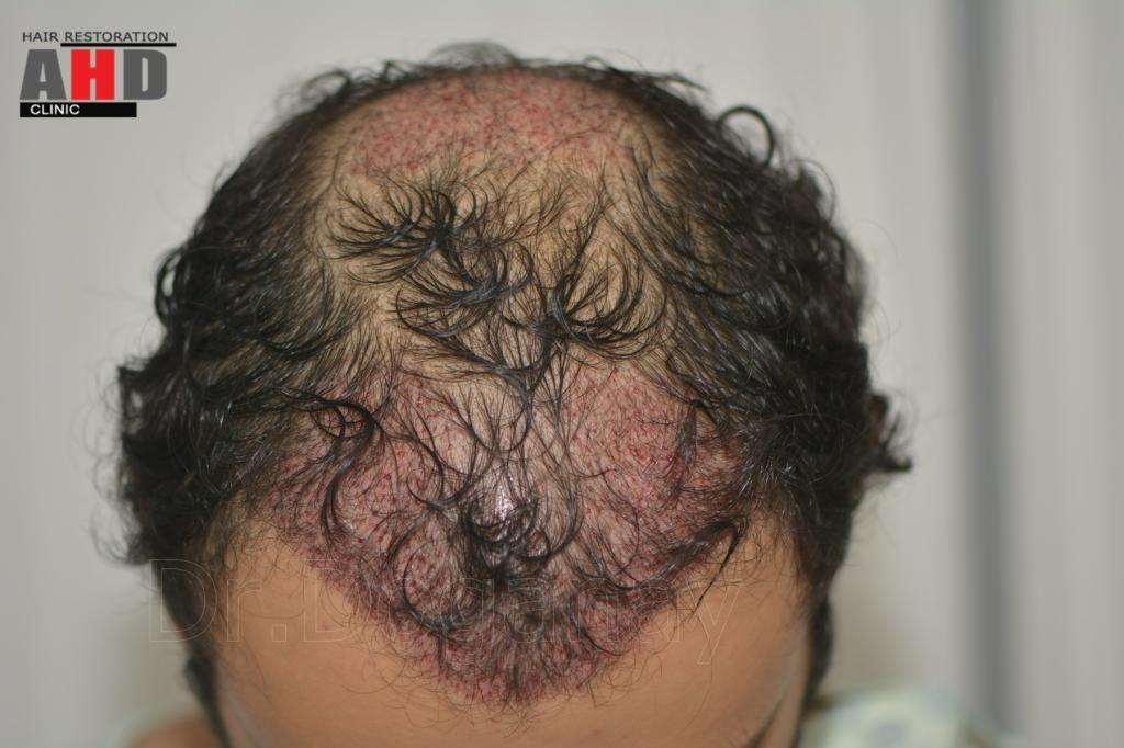 Identical twin hair transplant 12.jpg