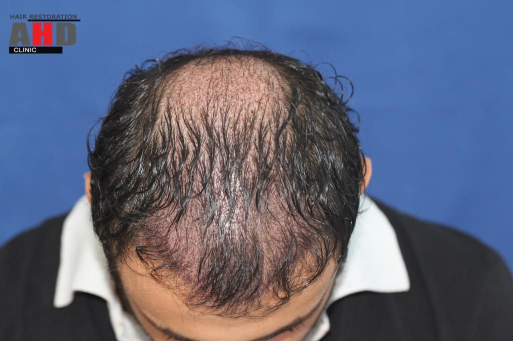 Identical twin hair transplant 13.jpg