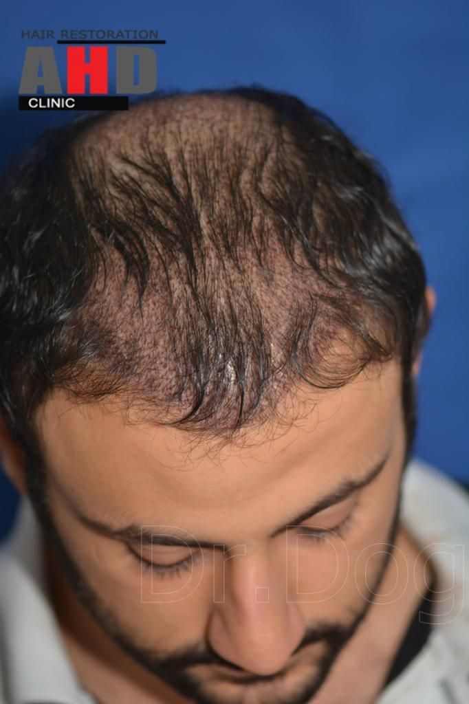 Identical twin hair transplant 14.jpg