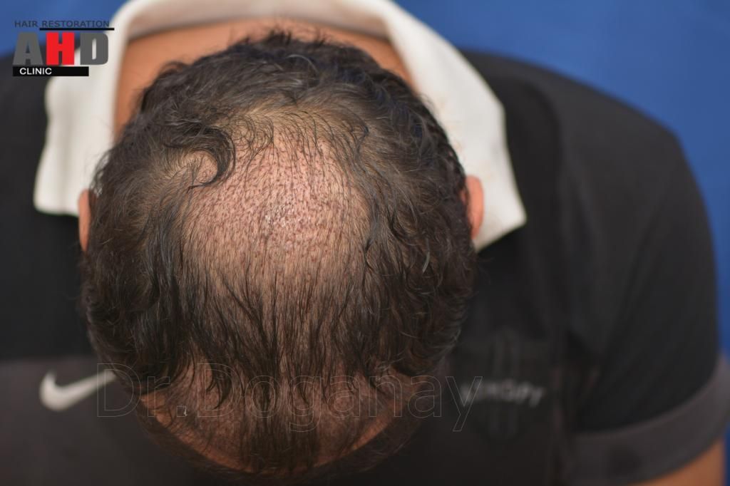 Identical twin hair transplant 15.jpg